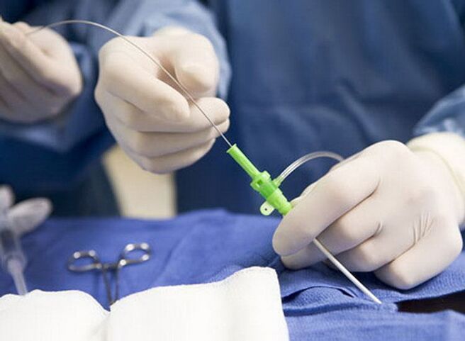 Ablația cu radiofrecvență